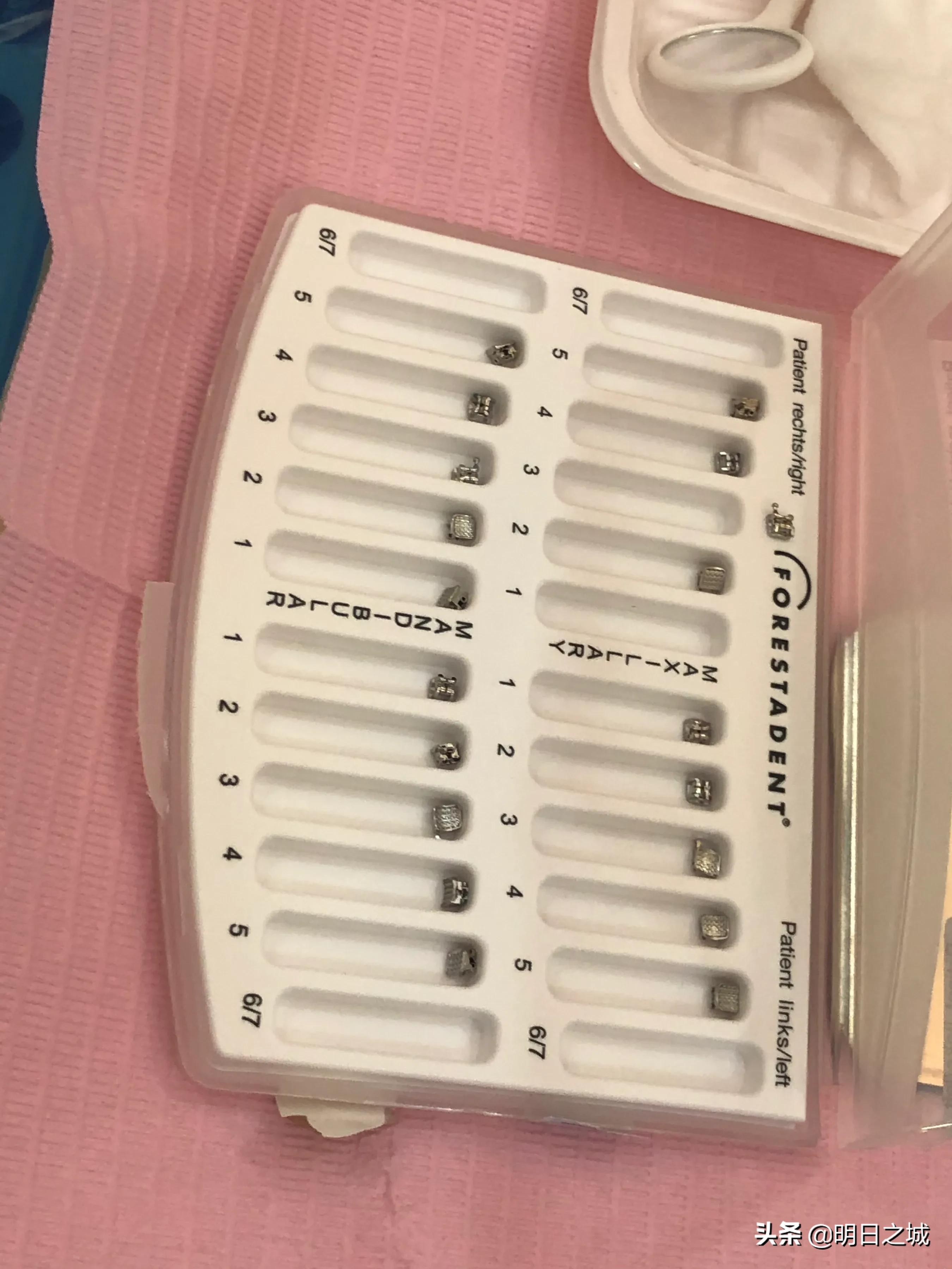 15岁女生矫正牙齿戴牙套全过程,12岁女孩牙齿矫正四颗牙一起拔牙