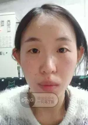 颅顶太低如何自救,颅顶低怎么自救