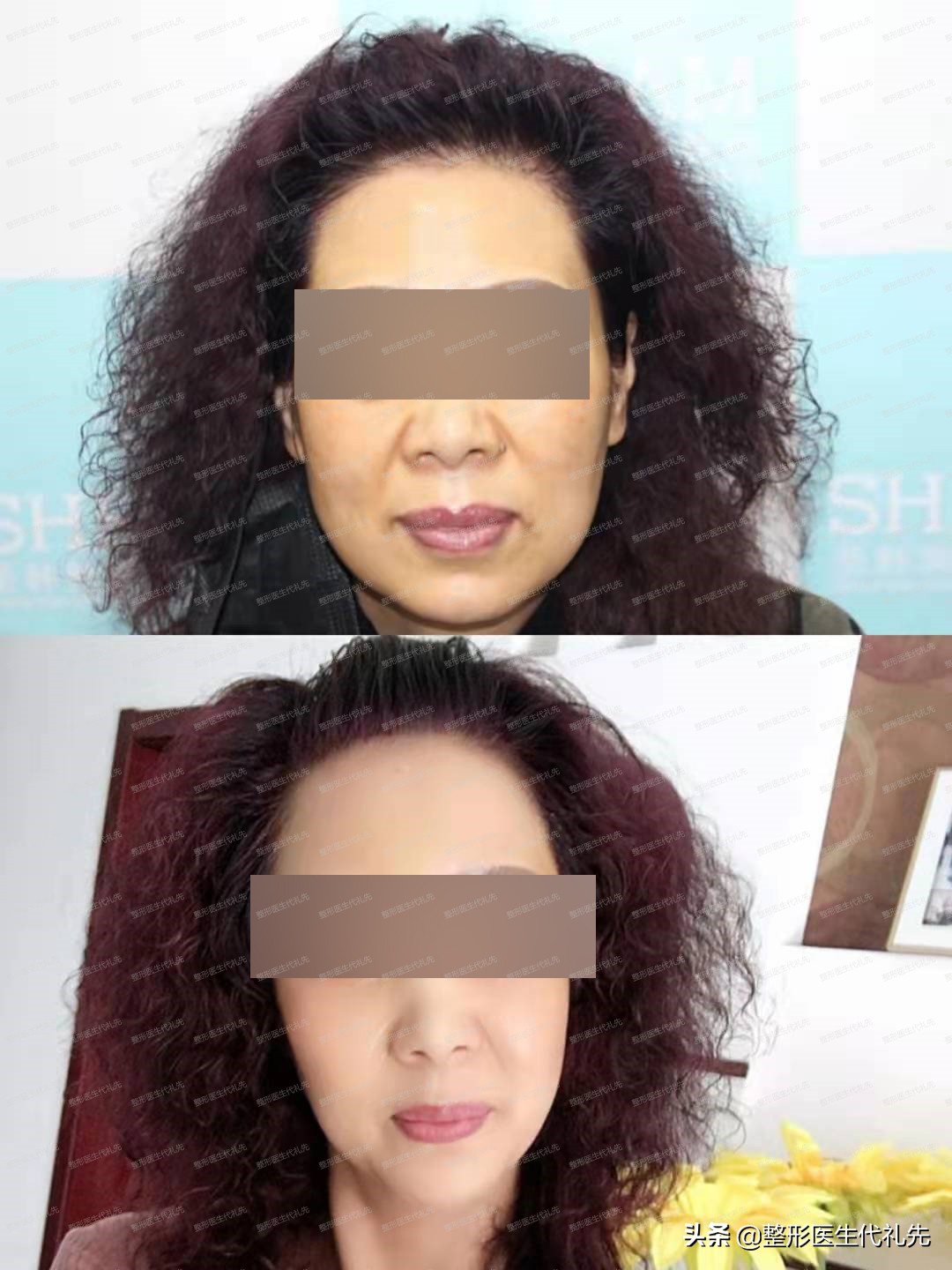 拉皮手术危险吗,做面部拉皮会损伤神经吗