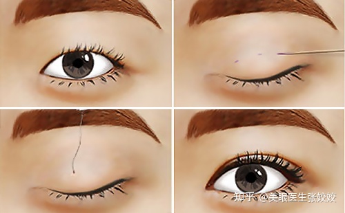 贴了双眼皮贴后的真实效果,贴双眼皮贴容易起翘