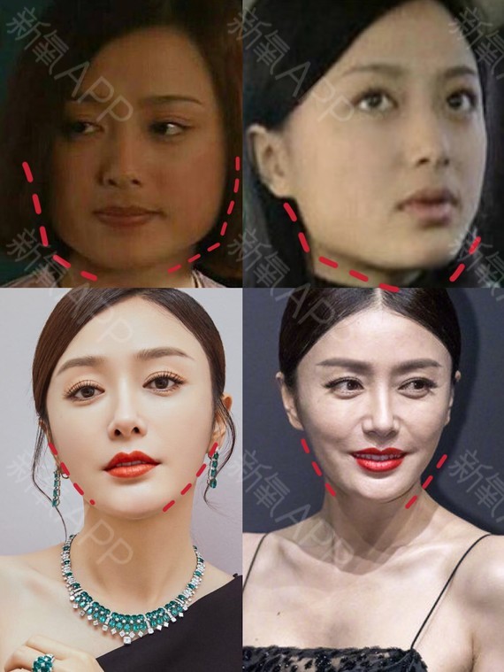 那些一刀切削骨的明星还好吗？后遗症一大堆，小方脸成最大赢家