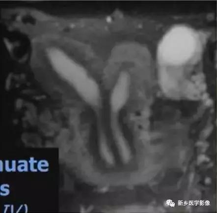 常见的几种子宫畸形诊断标准,先天性子宫畸形是什么原因造成的