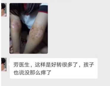 中医解释湿疹痒的原因,皮肤起湿疹怎么办