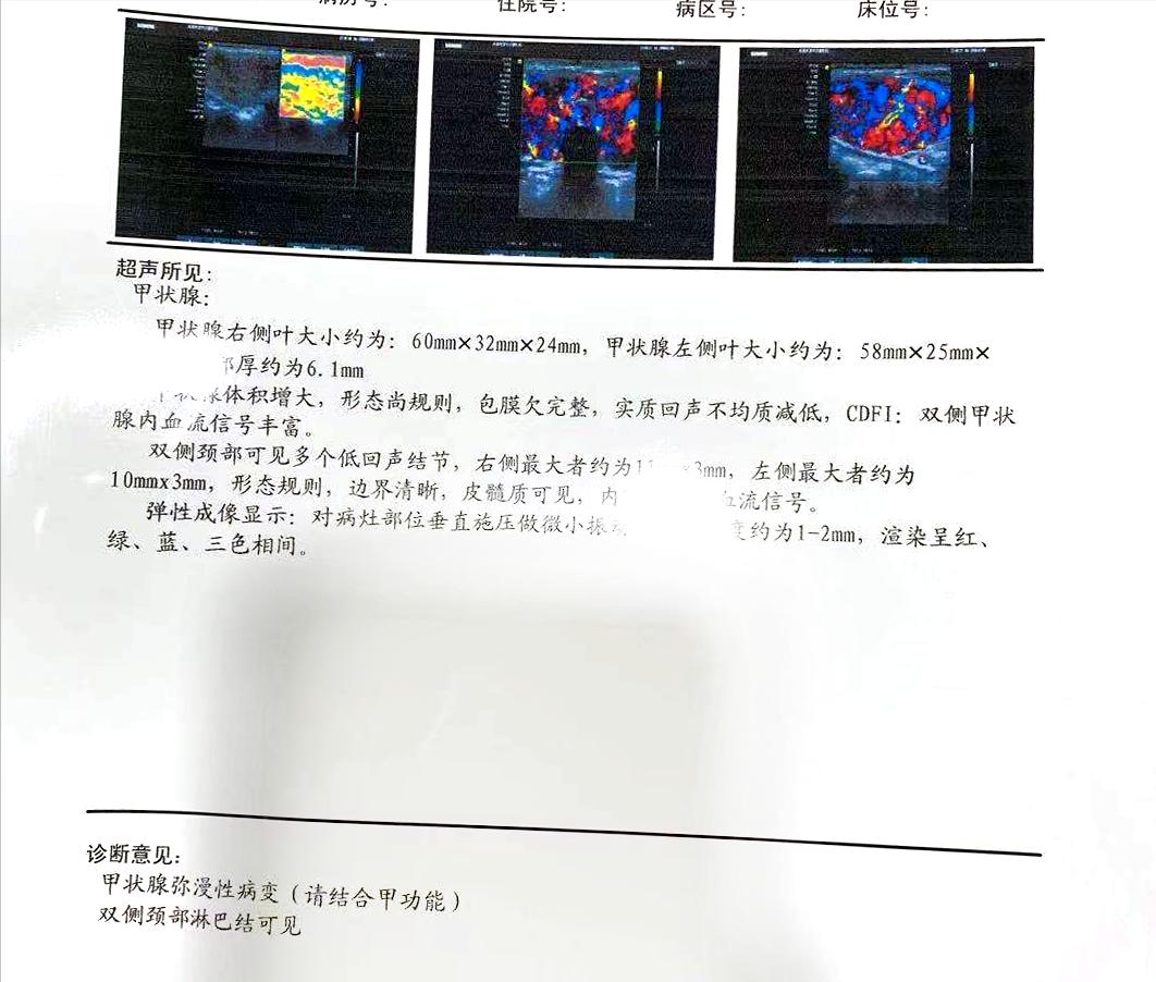 甲亢引起的眼球突出多久能恢复,甲亢导致眼球突出四五年了