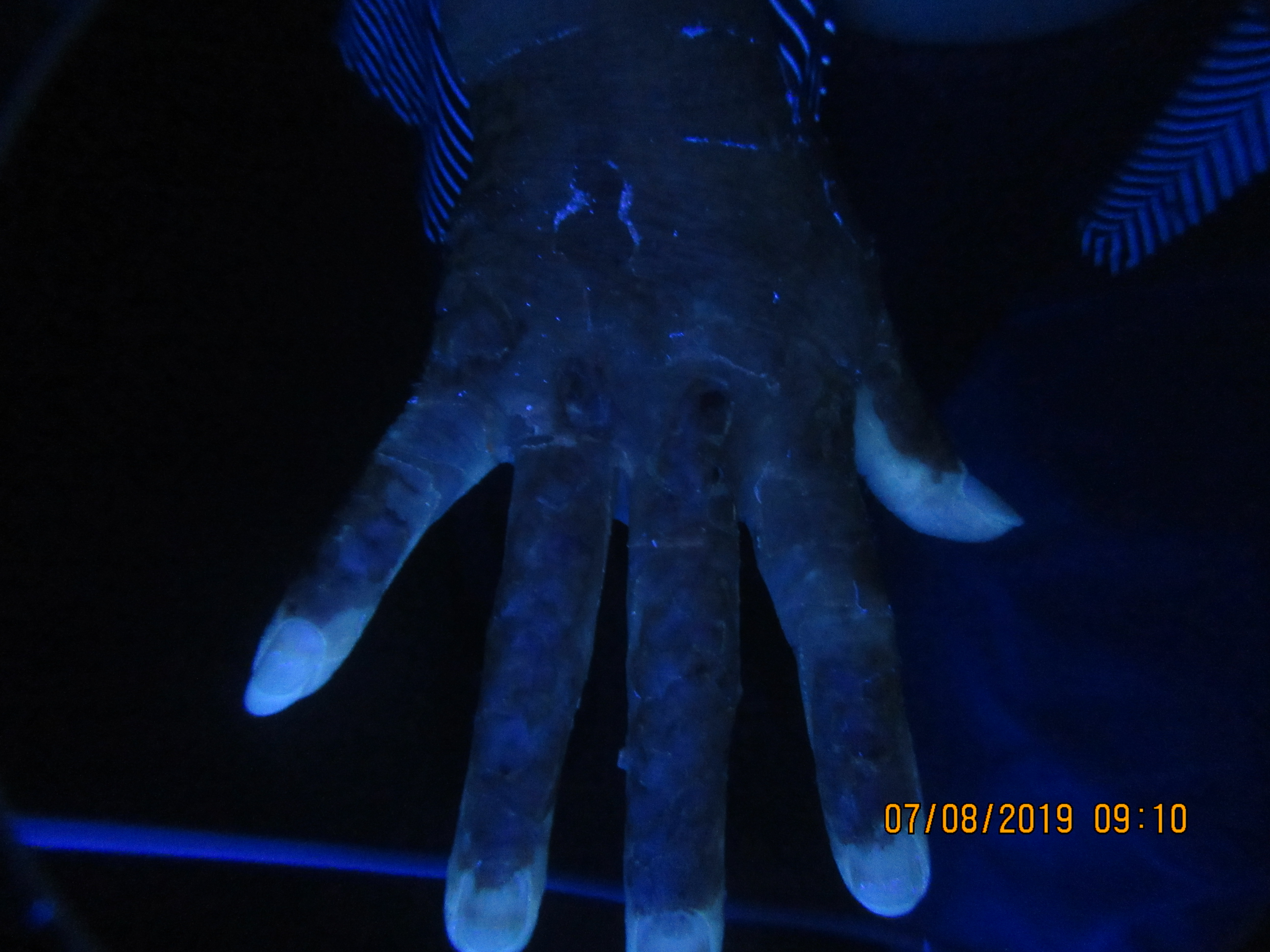 肢端型白癜风最佳治疗方案,肢端型白癜风怎么治疗