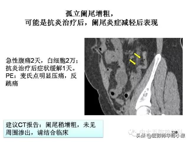 阑尾炎课件,阑尾炎的超声课件