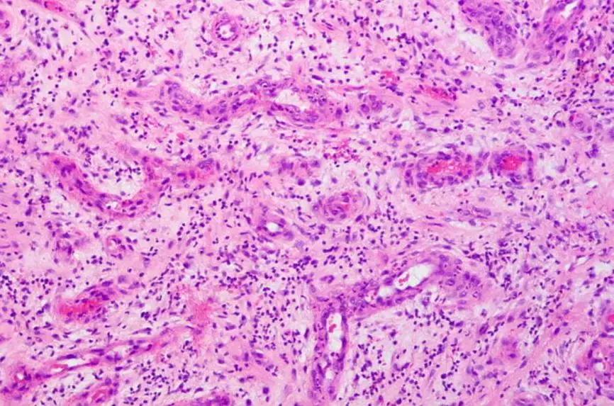 CACP2019:代华平:机化性肺炎的诊疗误区与防范