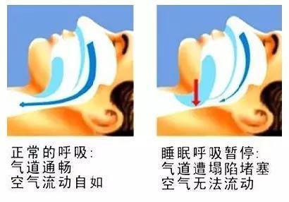 睡觉总是打呼噜用什么穴能治好,睡觉老是打呼噜的最快治疗方法