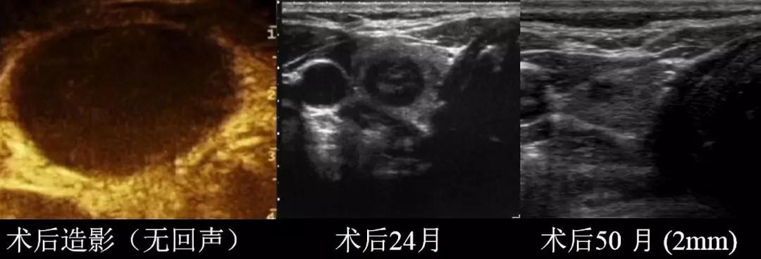 发现甲状腺结节和乳腺结节怎么办,怀孕后发现甲状腺结节4a级怎么办