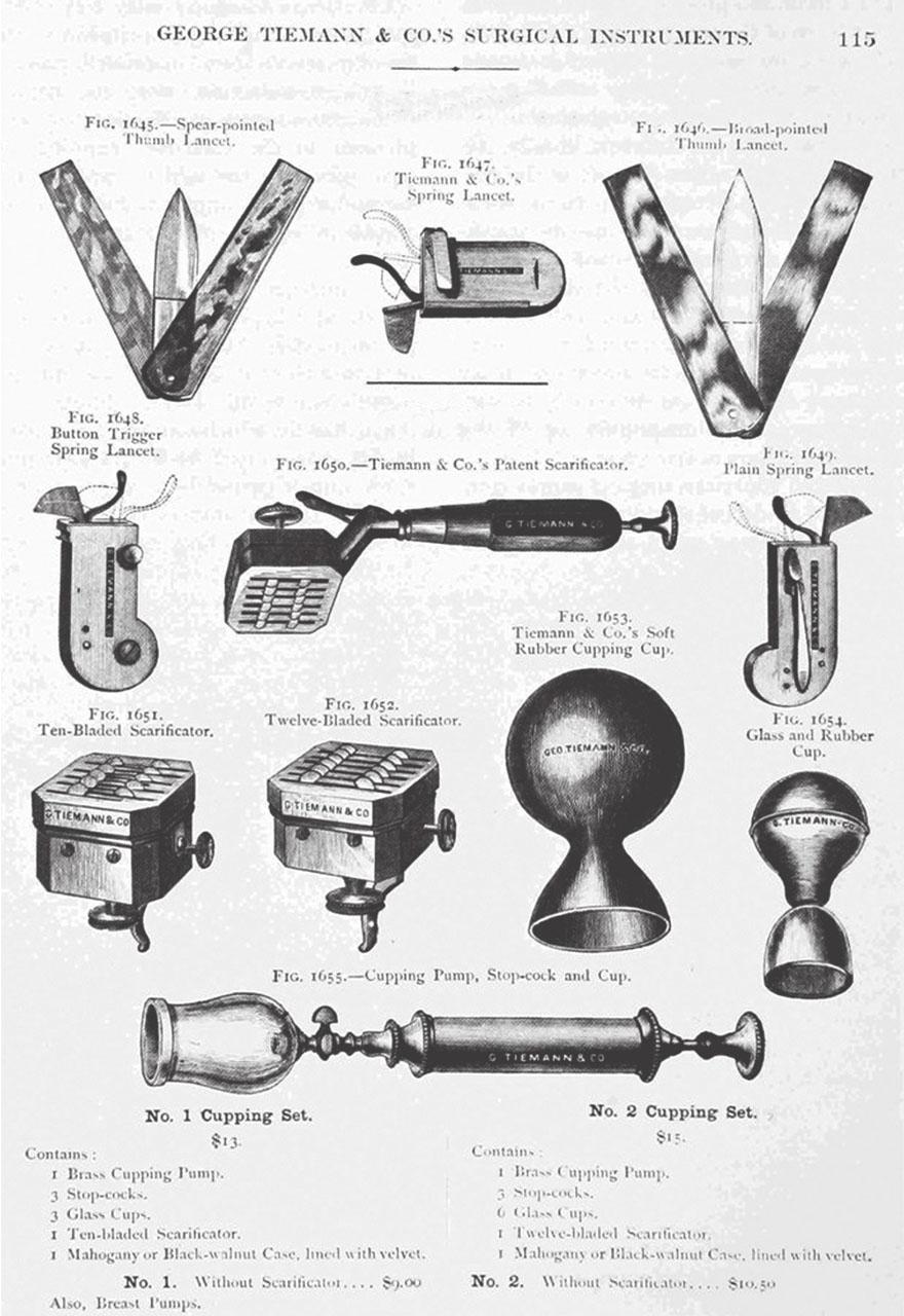 欧洲水蛭放血治疗,外国人用水蛭放在身上治病