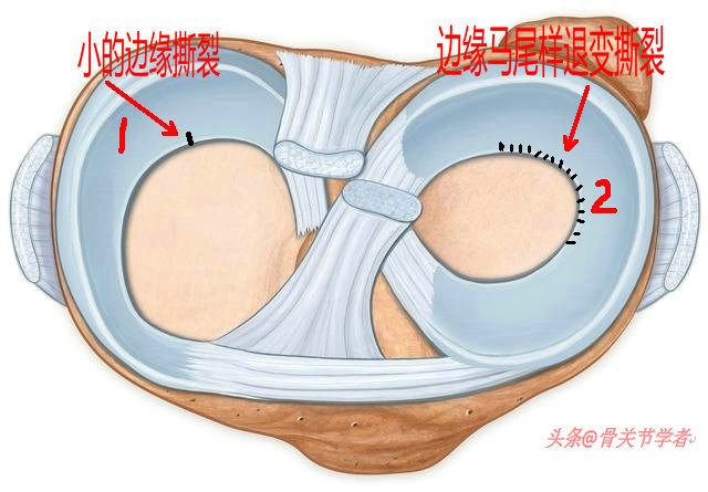 膝关节磁共振如何识别半月板损伤,磁共振半月板越来越严重怎么回事