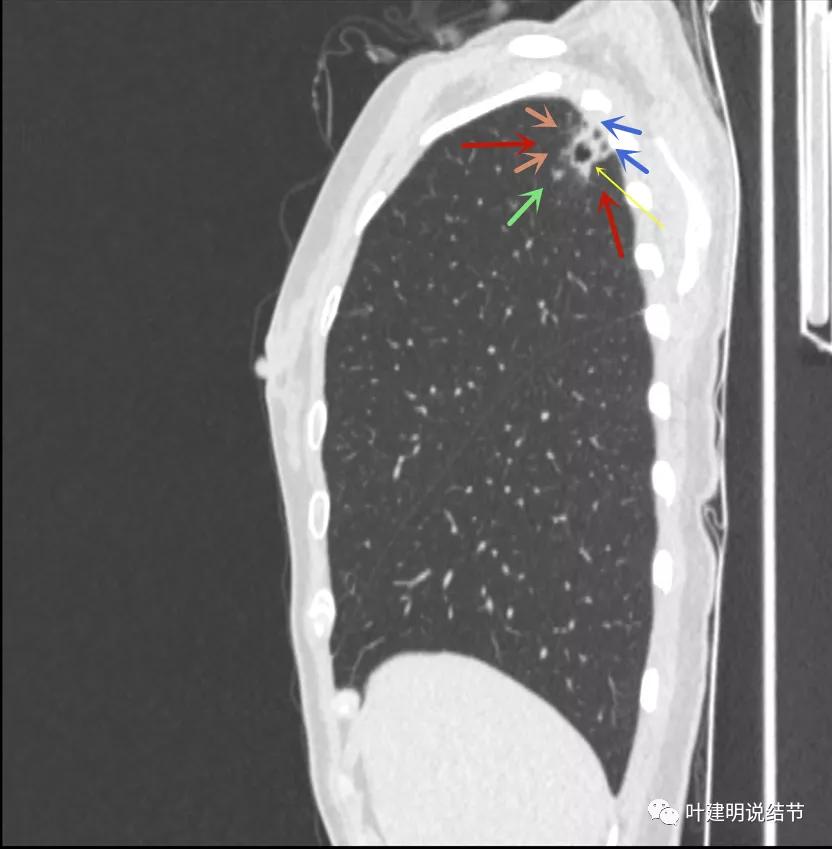 临床诊断孤立性肺结节,空洞型结节一般是什么性质