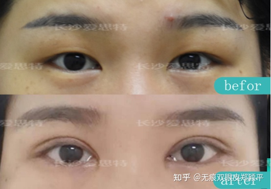 割双眼皮几毫米最好看,割双眼皮真的会好看吗