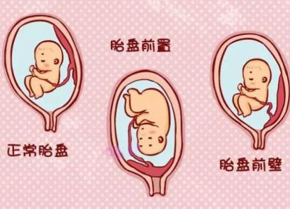 胎盘前壁与宫壁分界不清,胎盘前置跟前壁有区分吗