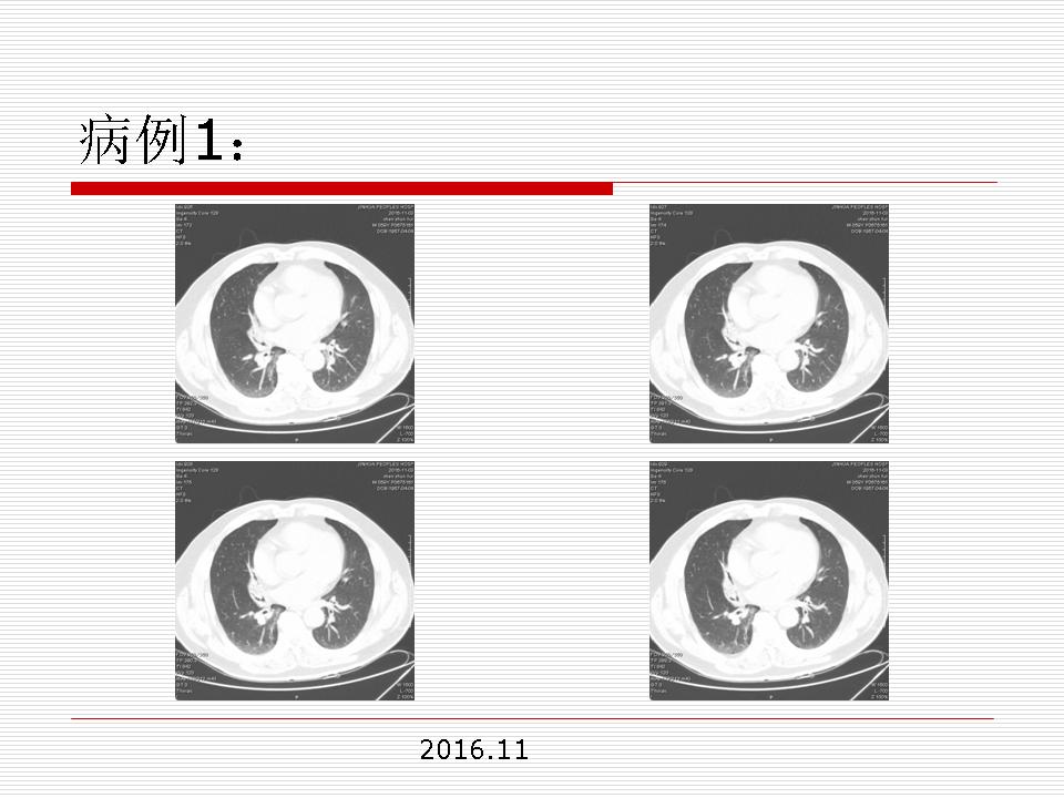 像炎症的肺癌能治好吗,医生说可能是肺癌也可能是炎症