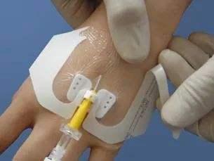 关于留置针的科普,留置针的四大注意事项