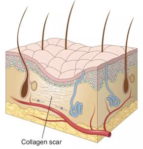 让无数姑娘无从下手的痘印，皮肤科医生有了解决新招