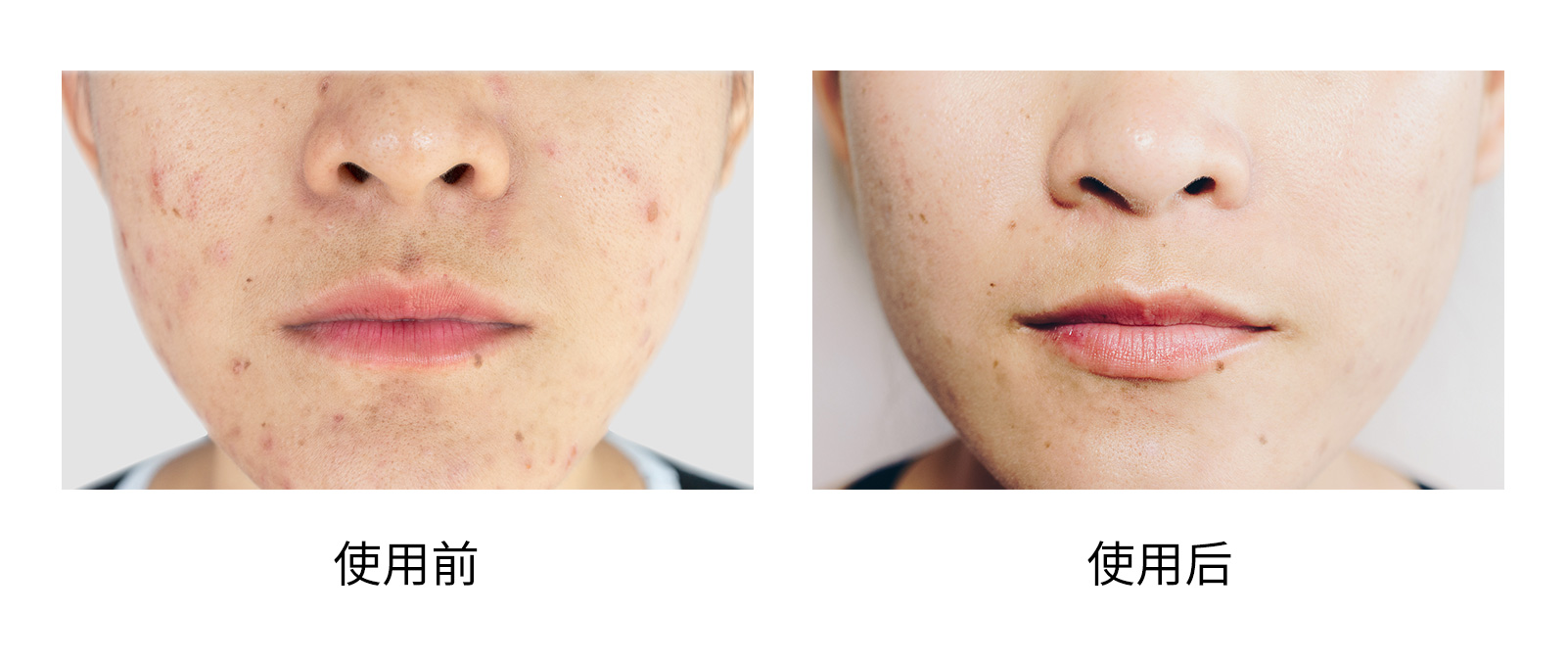 皮肤美容激光术后护理｜科普篇