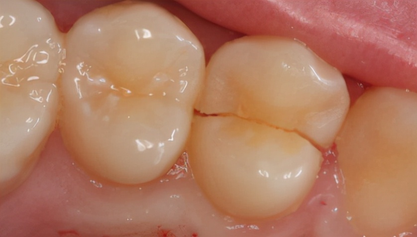 天冷牙就酸疼怎么回事,牙又酸又冷怎么办