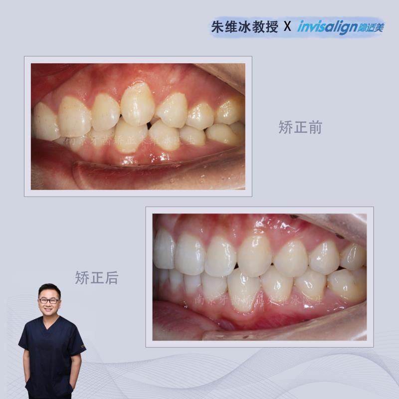 牙齿重度拥挤不拔牙正畸成功案例,南京牙齿矫正舌侧