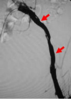 举例科普|介入能治疗哪些疾病?
