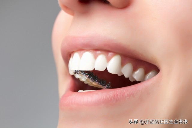 各种牙套的弊端,各种牙套的优缺点是什么