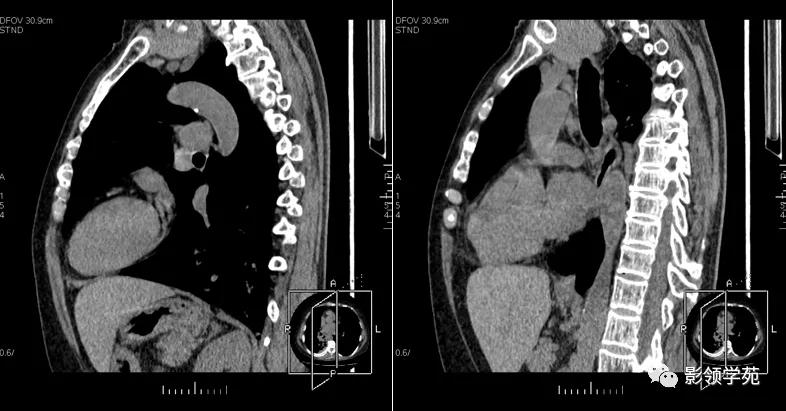 纵隔和肾上腺恶性肿瘤,纵隔性肿瘤位置图