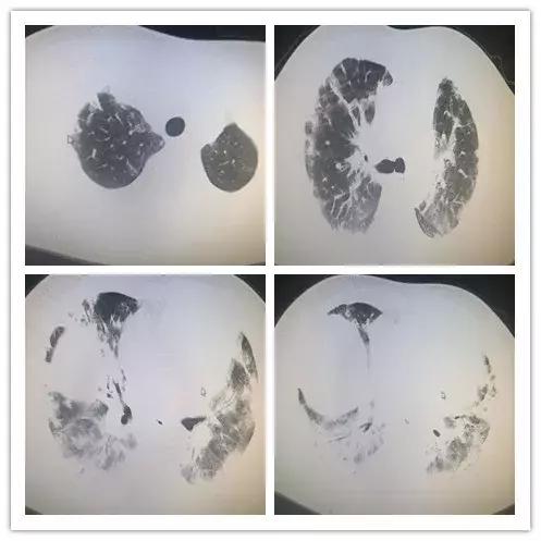 罕见病误诊的真实案例,误诊漏诊导致病人肿瘤癌变