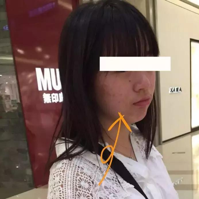 鎷晳鐥樼棙鐨勯粦绉戞妧,鎷晳鐥樿倢鐑傝劯