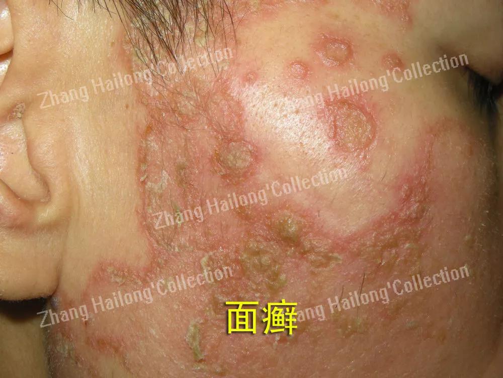 脸上长癣是怎么回事,12岁女孩脸上长癣
