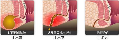肛瘘引起全身感染和炎症,肛瘘反复发作转为癌症