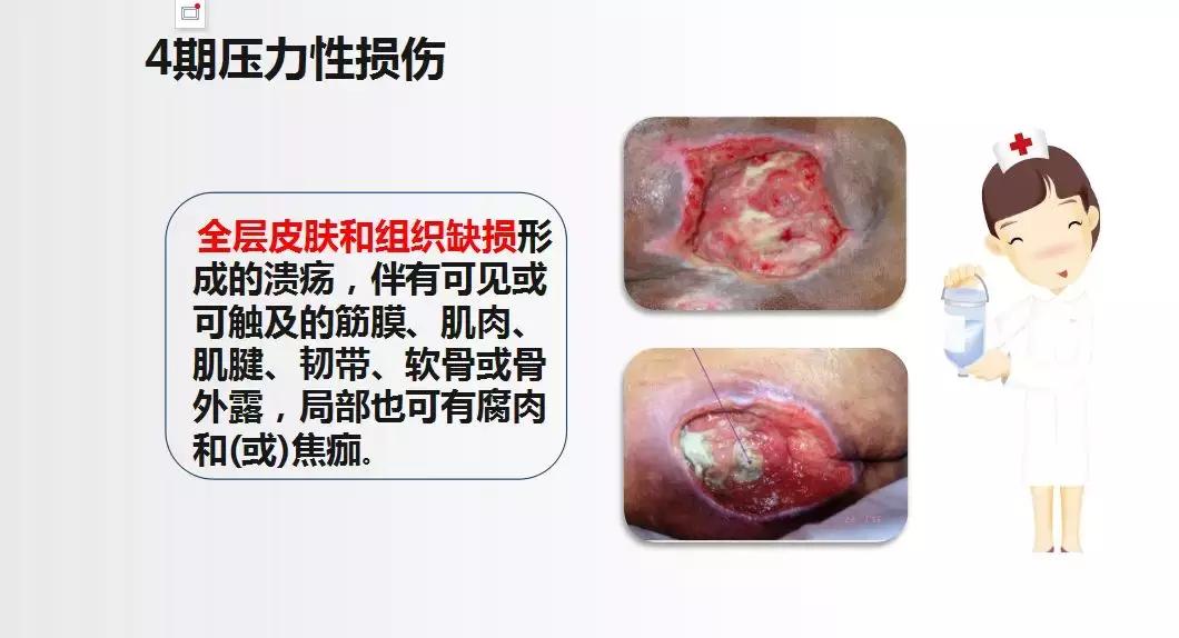 面对压疮不要慌,护理小妙招帮你忙!