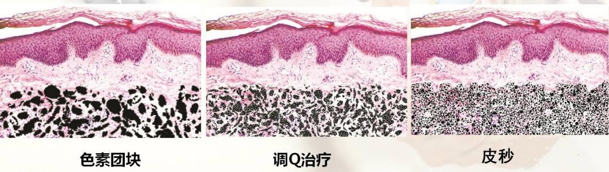 脸上长斑是激光还是用祛斑产品好,50岁年龄脸上长斑怎样能祛斑