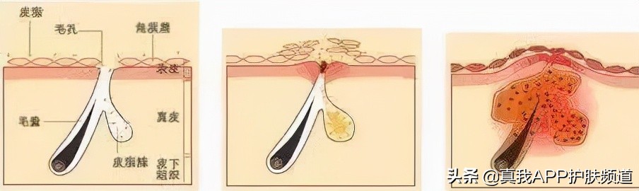 怎么去掉背上的痘痘,去掉脸上的痘痘最好办法