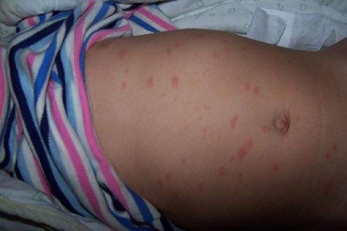 宝宝发烧退烧后起红点点怎么回事,宝宝发烧过后身体突然一抖为什么