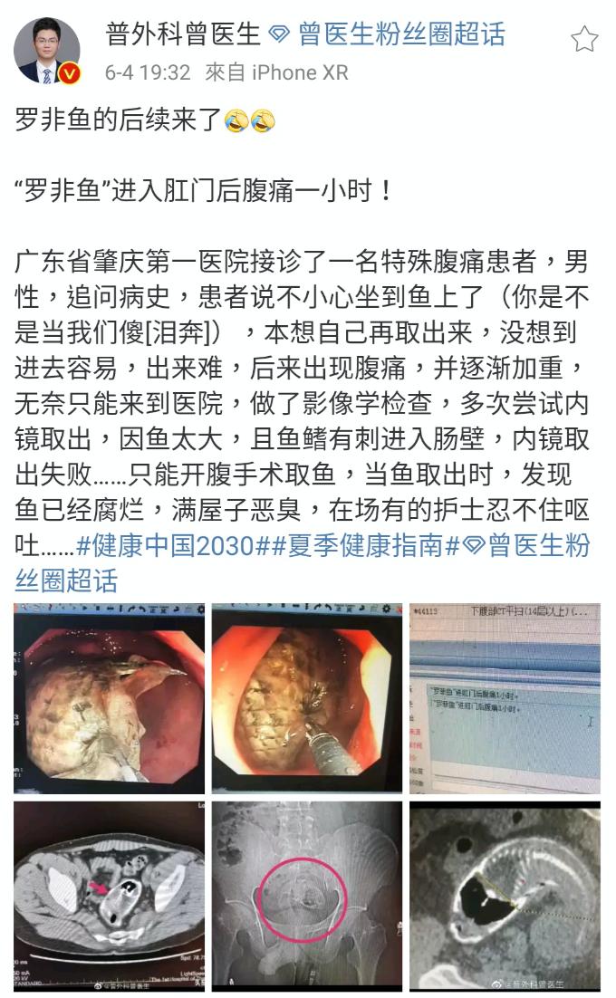 一条罗非鱼“游”进肛门?医生:直肠不直,进去容易出来难
