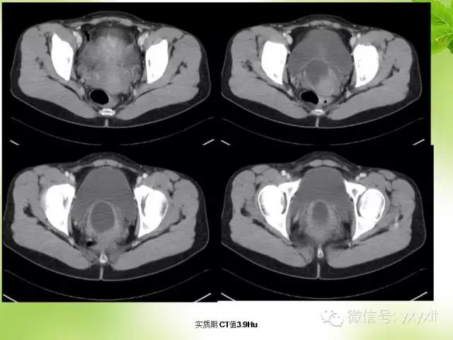 苗勒氏管囊肿在哪里,苗勒氏管囊肿是指什么