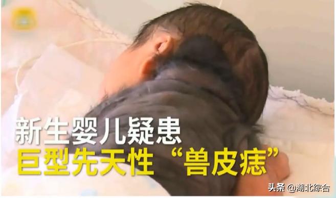 女孩脸上长巨痣,求医治疗却惨变“葫芦娃”?这些痣一定要当心