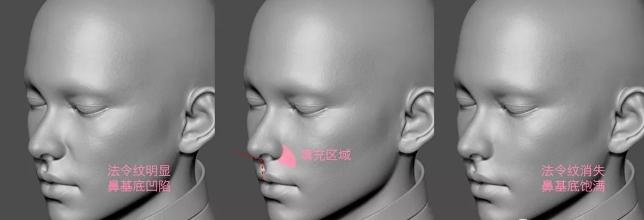 法令纹鼻基底填充玻尿酸方法,鼻基底底法令纹深怎么整