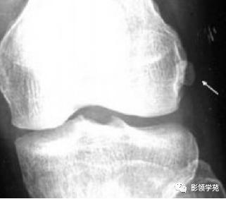 桡骨远端骨折引起尺骨变异,撕脱骨折一个月无明显骨痂形成