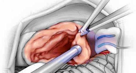 长了听神经瘤可以做微创手术吗？手术风险大吗？