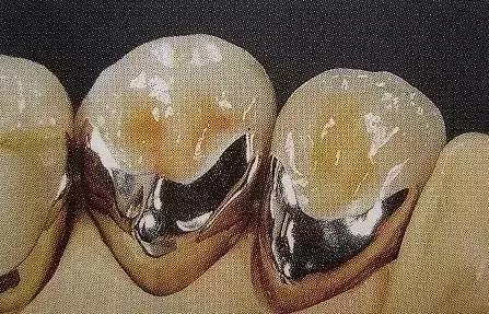 换一副烤瓷牙什么材料比较好,各类烤瓷牙材料的优缺点对比