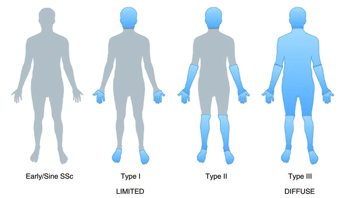 硬皮病是一种什么病,硬皮病由什么造成的
