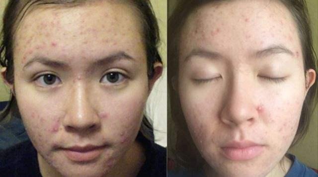 完美芦荟胶怎么用祛痘效果最好呢,完美芦荟胶和自然乐园哪个效果好