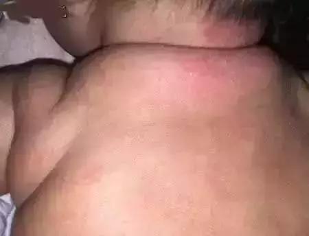 幼儿急疹和痱子怎么区分,宝宝急疹和痱子的区别