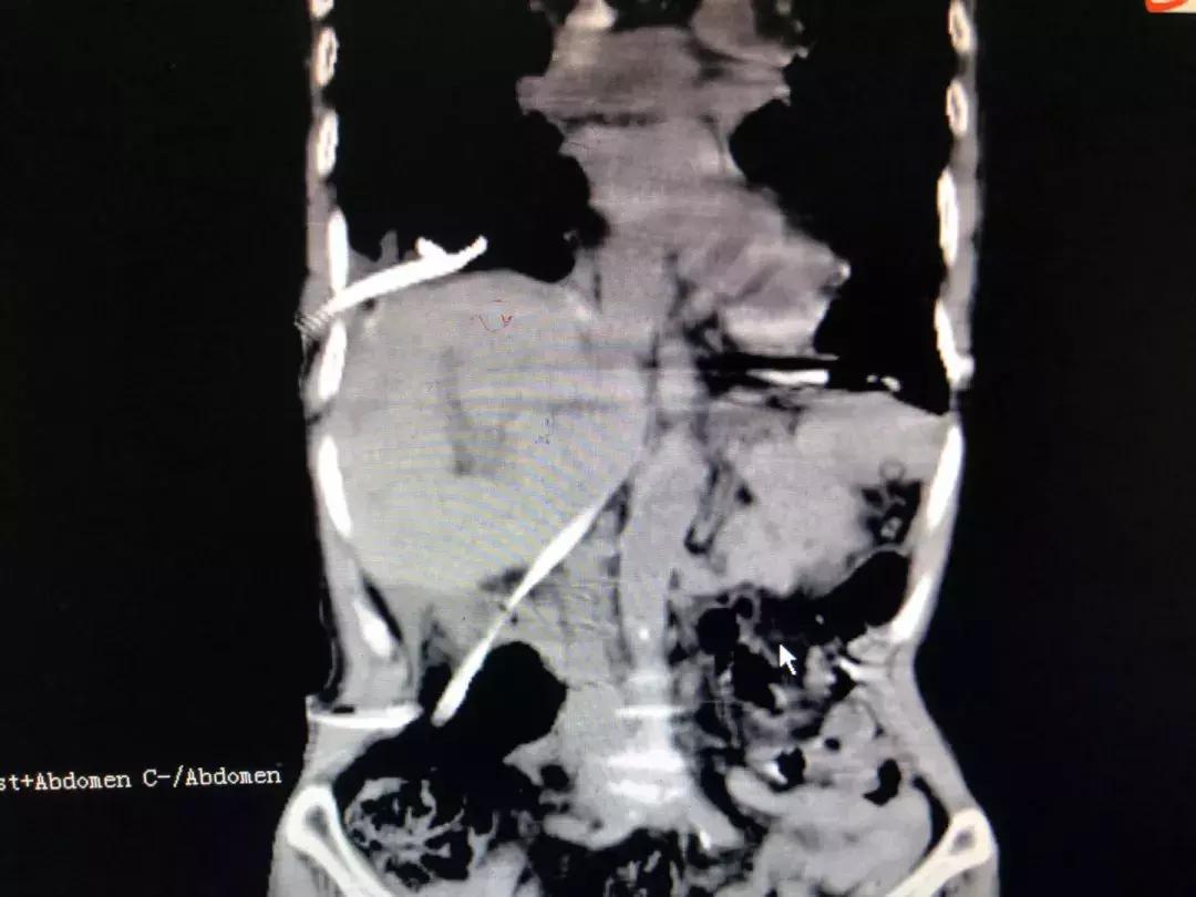 膈肌破裂修补术是大手术吗,膈肌缺损手术