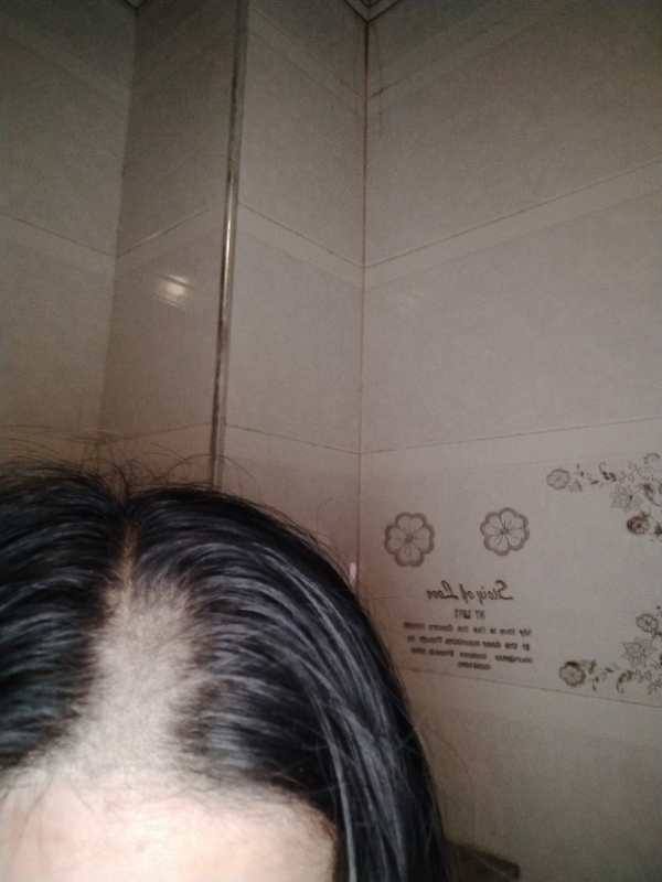 女子称入住酒店一觉醒来头秃一块酒店:无人进入房间