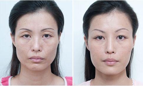 做美容的女人勇气可嘉,打了美容针的女人现在怎么样了