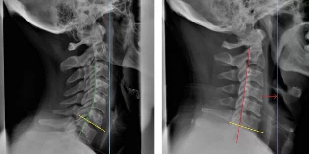颈椎康复就一招,改善颈椎的有效缓解方法