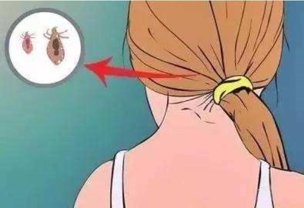 敌敌畏洗头杀虱,敌敌畏洗头去头虱